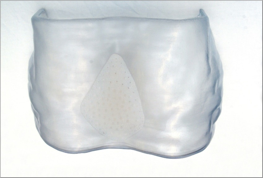 prosthesis