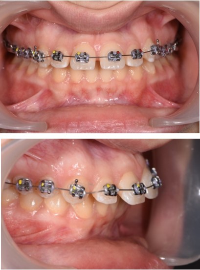 Journal of Dentistry And Oral Implants-Orthodontic implants