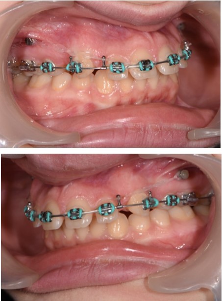 Journal of Dentistry And Oral Implants-Orthodontic implants