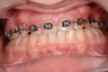 Journal of Dentistry And Oral Implants-Orthodontic implants