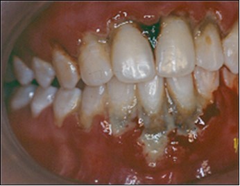 Journal of Dentistry And Oral Implants-Laser Er-YAG