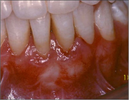 Journal of Dentistry And Oral Implants-Laser Er-YAG
