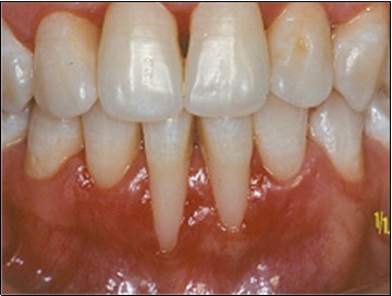 Journal of Dentistry And Oral Implants-Laser Er-YAG