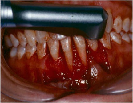 Journal of Dentistry And Oral Implants-Laser Er-YAG