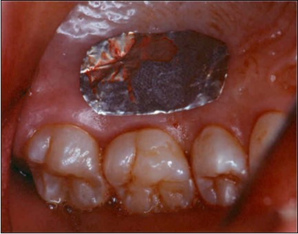Journal of Dentistry And Oral Implants-Laser Er-YAG