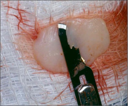 Journal of Dentistry And Oral Implants-Laser Er-YAG