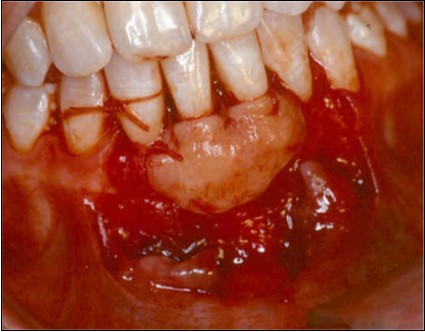 Journal of Dentistry And Oral Implants-Laser Er-YAG