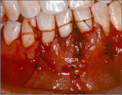 Journal of Dentistry And Oral Implants-Laser Er-YAG