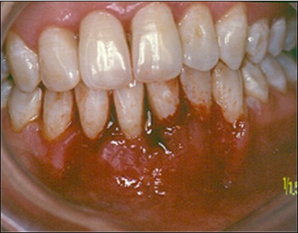 Journal of Dentistry And Oral Implants-Laser Er-YAG