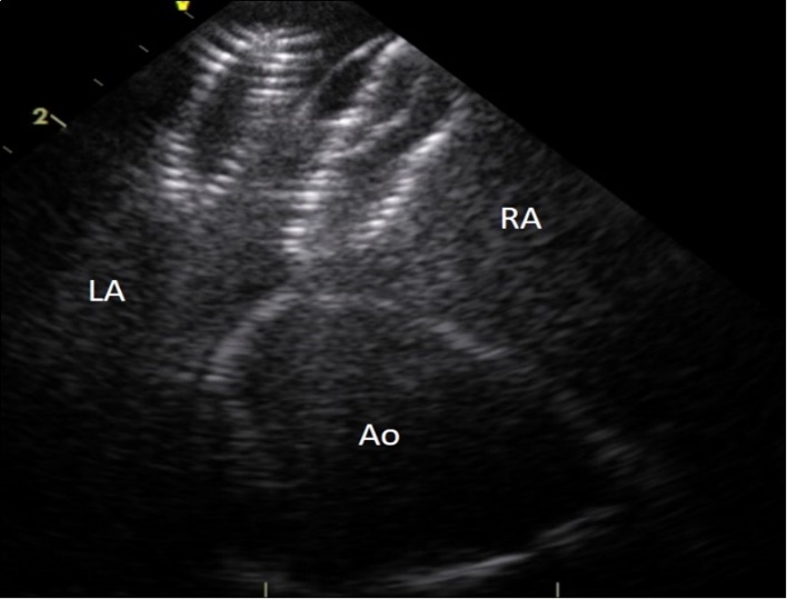 Journal of Clinical Case reports and Images-interventional cardiology