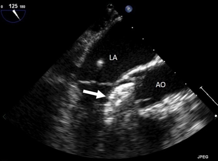 Journal of Clinical Case reports and Images-interventional cardiology