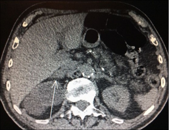 Journal of Respiratory Diseases-adrenal metastases