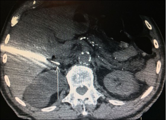 Journal of Respiratory Diseases-adrenal metastases