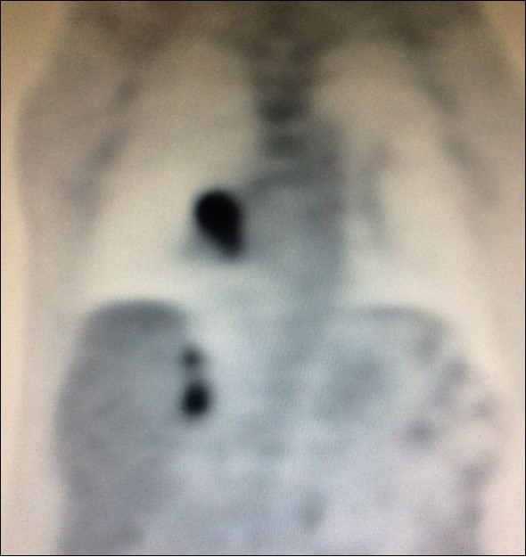 Journal of Respiratory Diseases-adrenal metastases