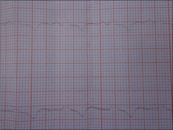 Journal Of Hypertension And Cardiology-Hydatid cyst