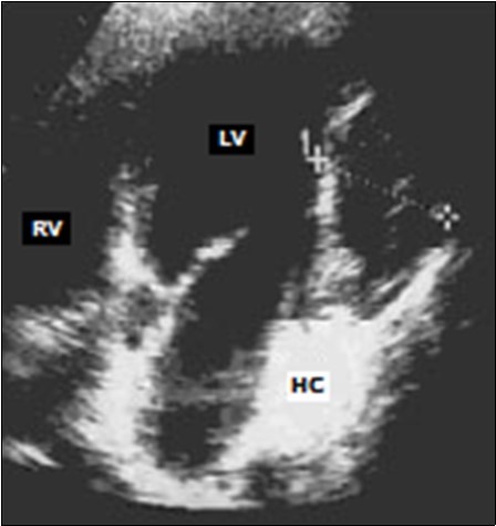 Journal Of Hypertension And Cardiology-Hydatid cyst