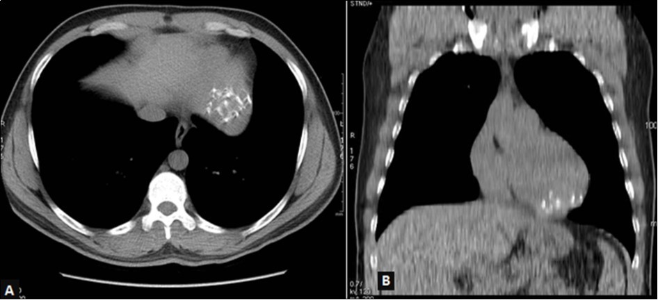 Journal Of Hypertension And Cardiology-Hydatid cyst