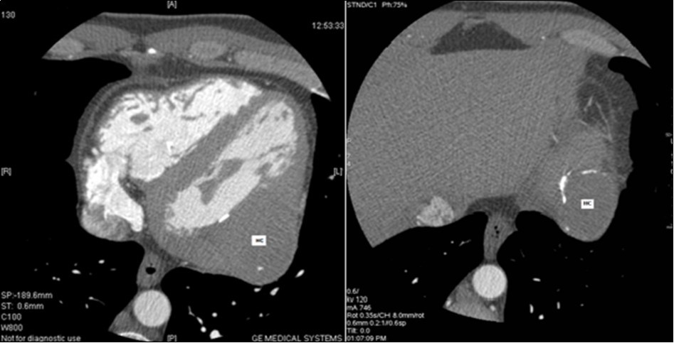 Journal Of Hypertension And Cardiology-Hydatid cyst