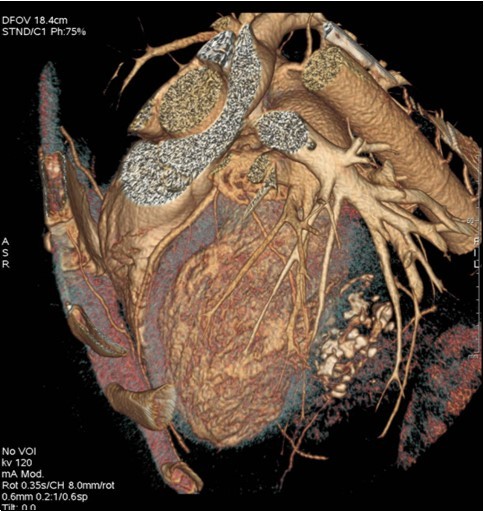 Journal Of Hypertension And Cardiology-Hydatid cyst
