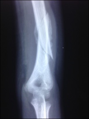 Low-level laser therapy