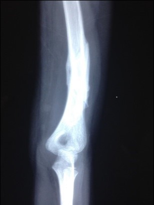 Low-level laser therapy