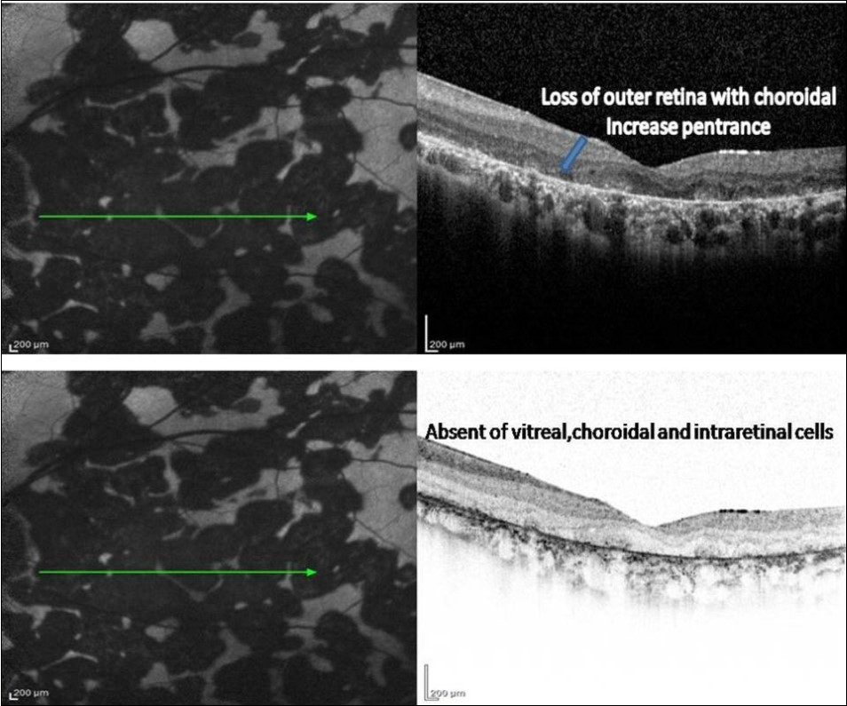 Journal of Ophthalmic Science-Serpiginous multifocal choroiditis