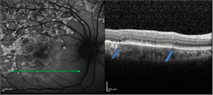 Journal of Ophthalmic Science-Serpiginous multifocal choroiditis