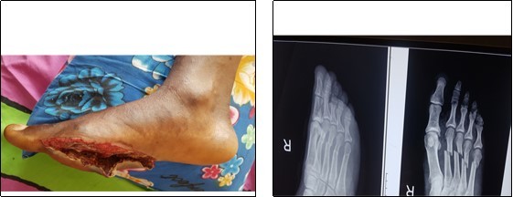 Journal of Preventive Medicine And Care-Open fracture