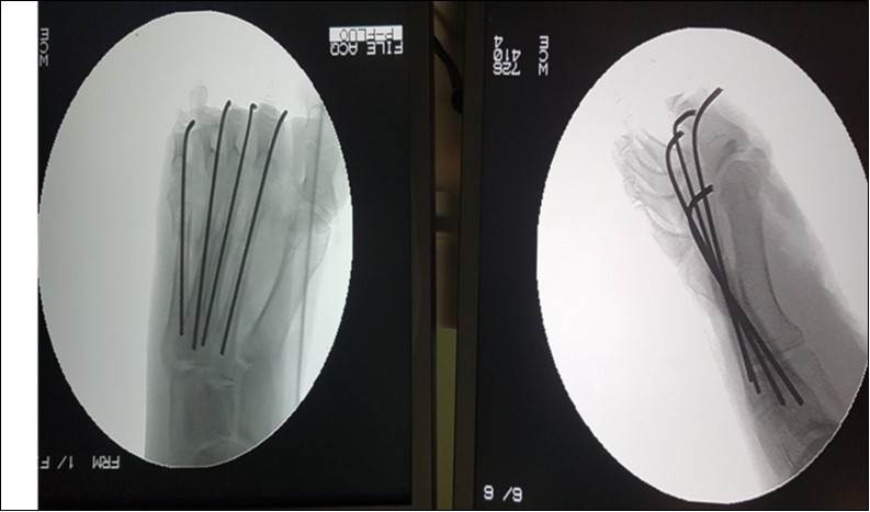 Journal of Preventive Medicine And Care-Open fracture