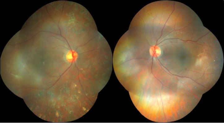 Journal of Ophthalmic Science-Resolving Vitreous Hemorrhage