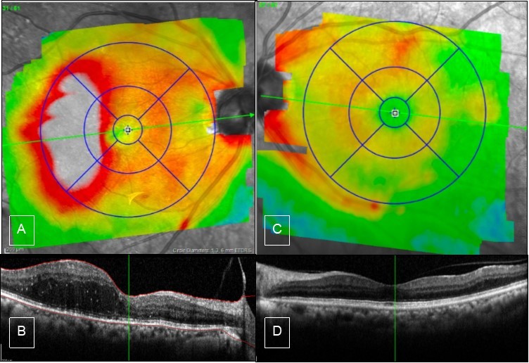 Journal of Ophthalmic Science-Resolving Vitreous Hemorrhage