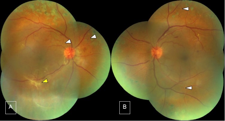 Journal of Ophthalmic Science-Resolving Vitreous Hemorrhage