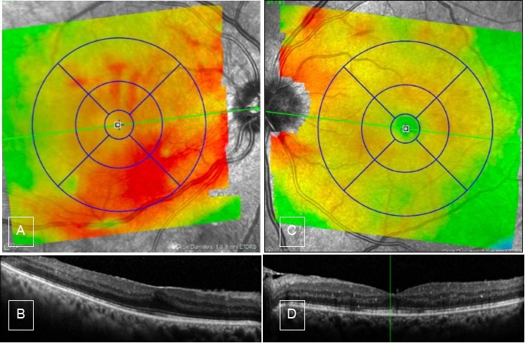 Journal of Ophthalmic Science-Resolving Vitreous Hemorrhage