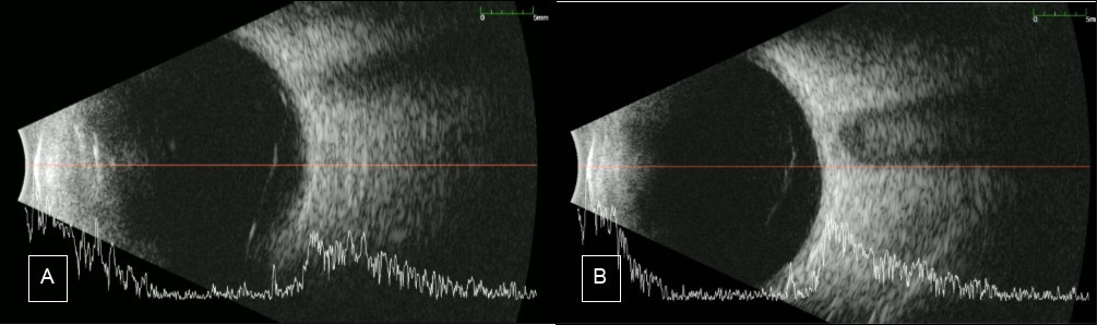 Journal of Ophthalmic Science-Resolving Vitreous Hemorrhage