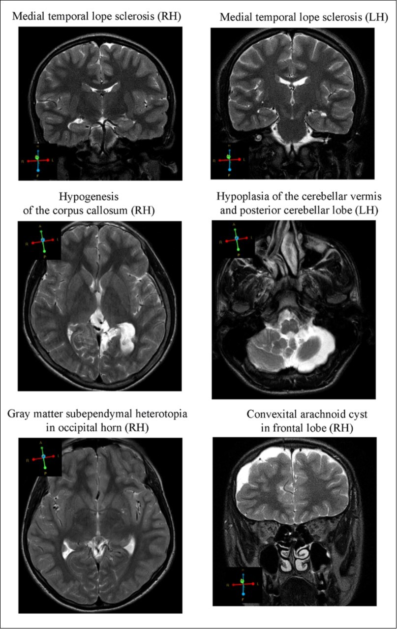 MRI
