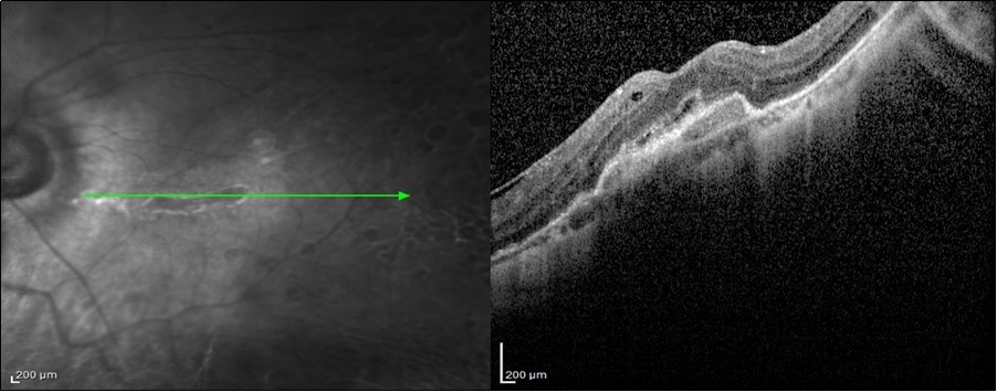 Journal of Ophthalmic Science-SD-OCT