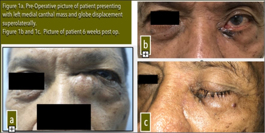 Journal of Ophthalmic Science-Inverting Papilloma