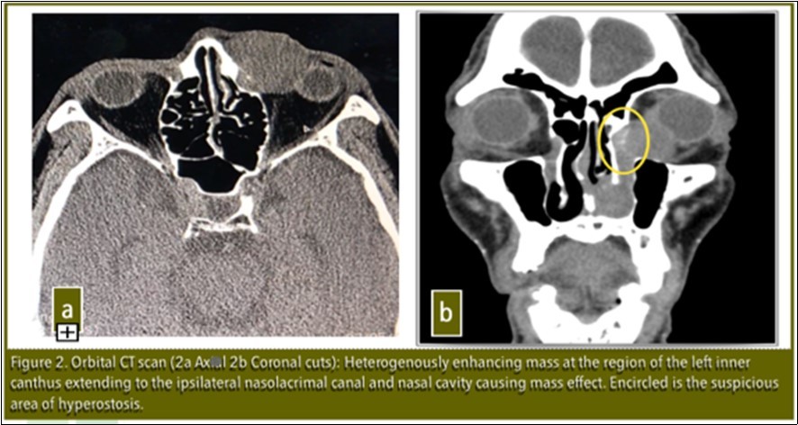 Journal of Ophthalmic Science-Inverting Papilloma