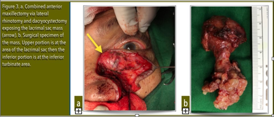 Journal of Ophthalmic Science-Inverting Papilloma