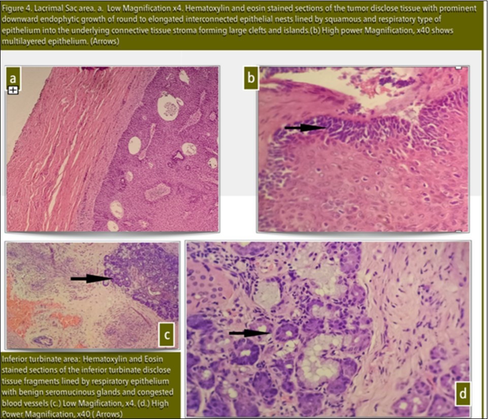 Journal of Ophthalmic Science-Inverting Papilloma