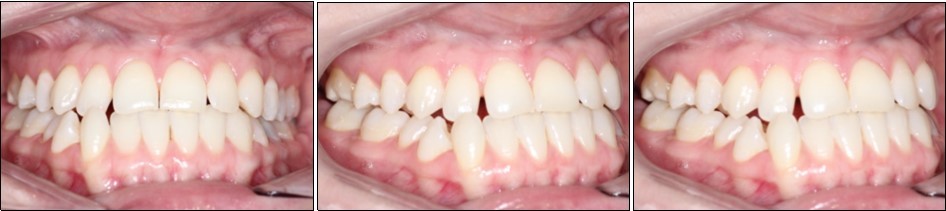 Journal of Dentistry And Oral Implants-sagital skeletal discrepancies