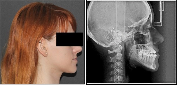 Journal of Dentistry And Oral Implants-sagital skeletal discrepancies