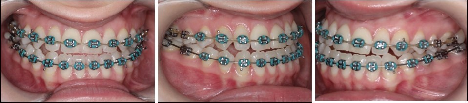 Journal of Dentistry And Oral Implants-sagital skeletal discrepancies