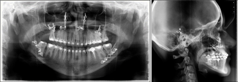 Journal of Dentistry And Oral Implants-sagital skeletal discrepancies