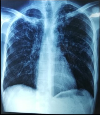 Intestinal tuberculosis diagnosis