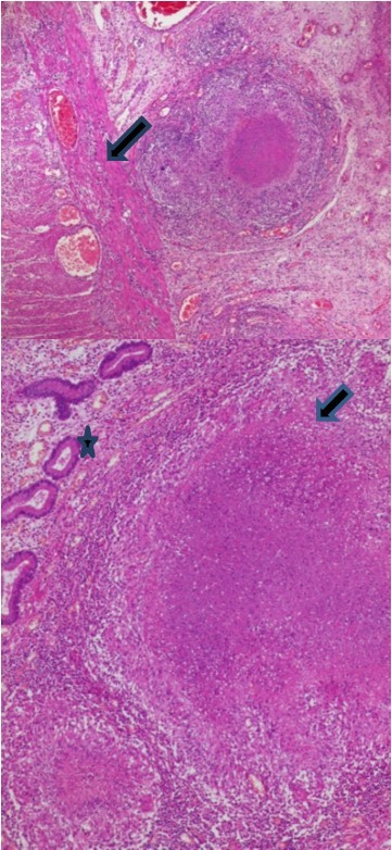 Intestinal tuberculosis diagnosis