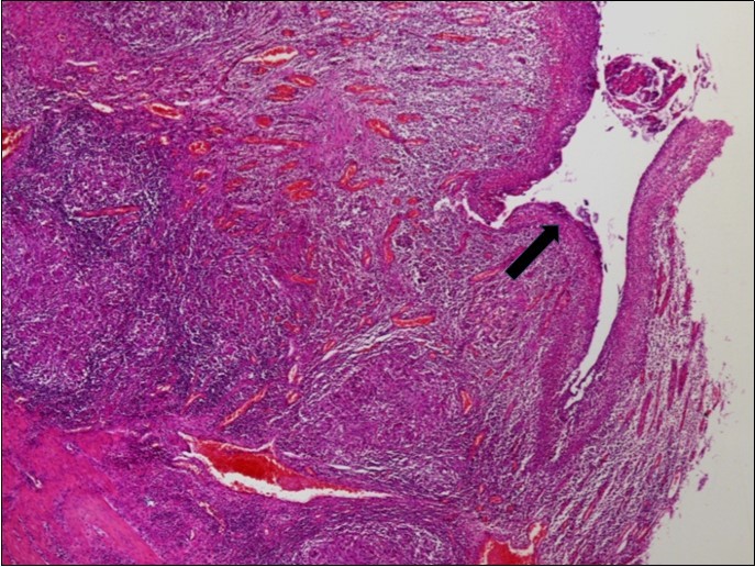 Intestinal tuberculosis diagnosis