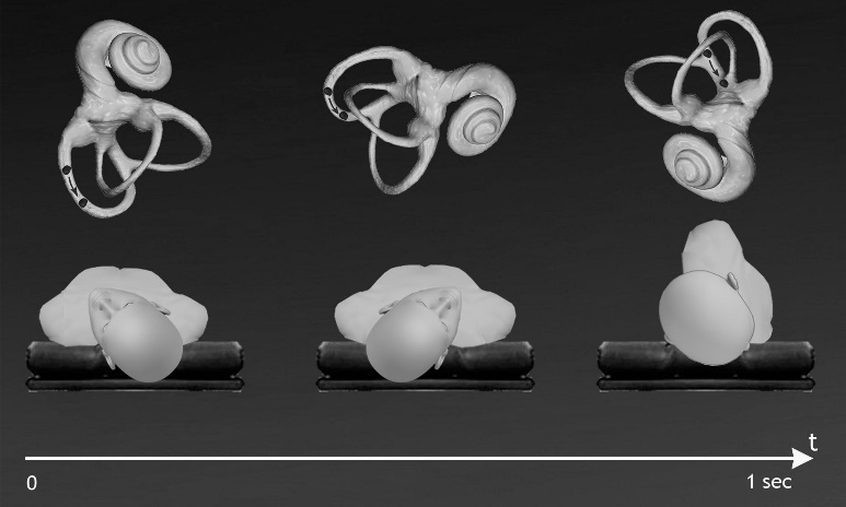 Journal of Otolaryngology Advances-Posterior canal BPPV