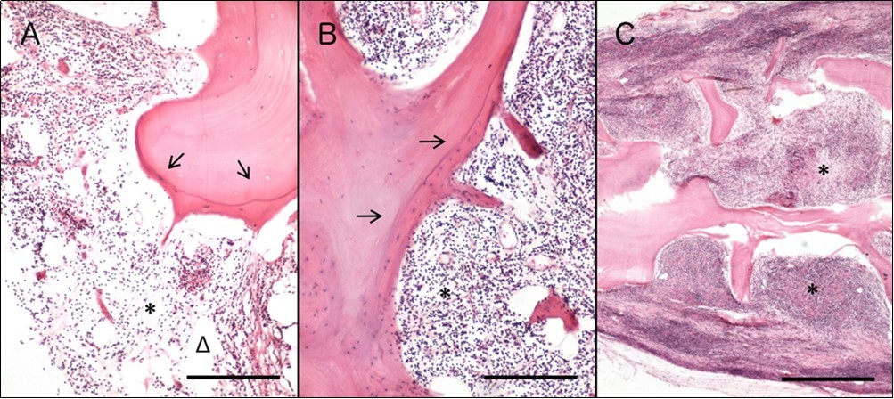 Journal of Hematalogy and Oncology Research-Waldenström Macroglobulinemia
