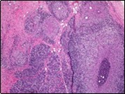 International Journal of Infection Prevention-Chronic